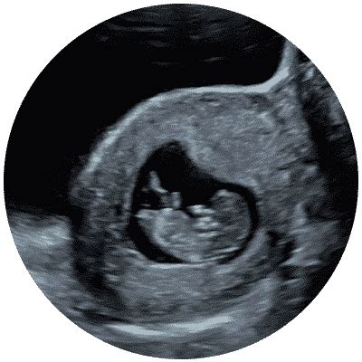 how accurate is a dating scan at 10 weeks